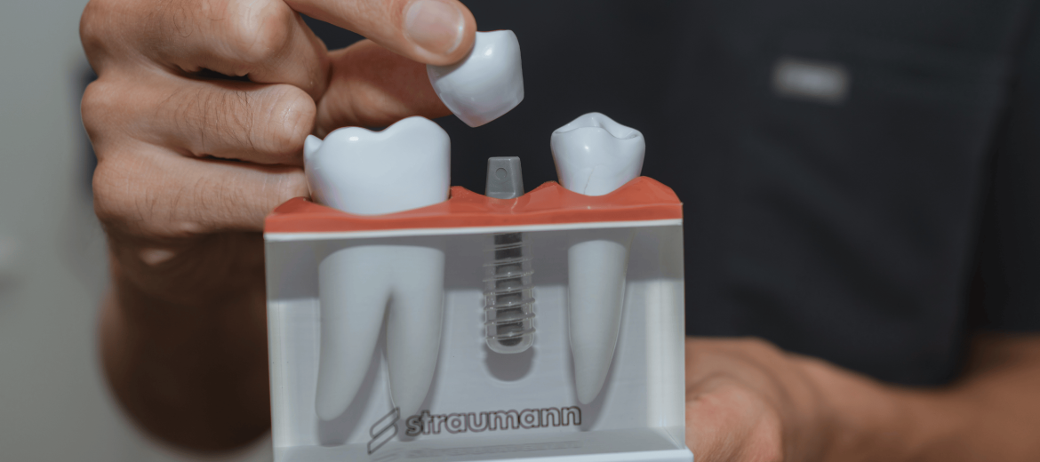 Dental Implants