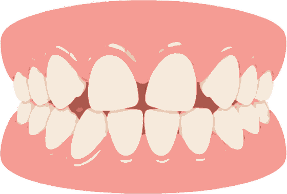 Illustration of crooked and rotated teeth